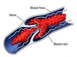 Diagram of a blood clot blocking blood flow in a blood vessel.